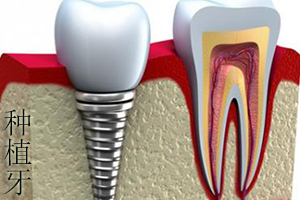 种植牙的手术流程是什么？