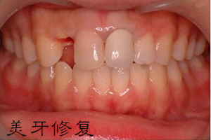 牙齿磕掉一半
