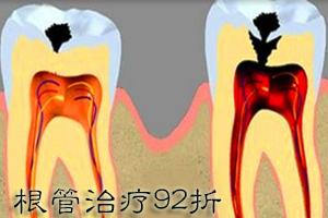 合肥根管的治疗多少钱？