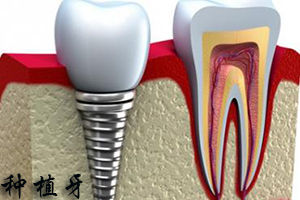 快速种植牙有哪些优点呢？