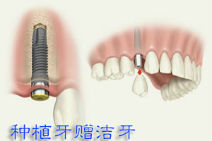 种植牙