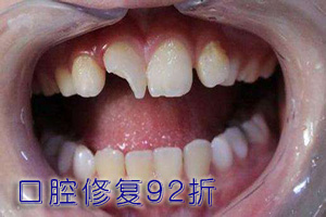 牙齿摔断一半