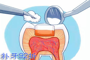 怎样防止补牙材料脱落？