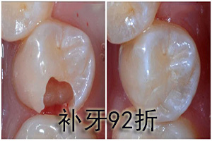 补牙需要多长时间