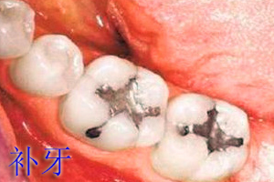 合肥补牙多少钱一颗？