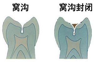 合肥窝沟封闭多少钱？