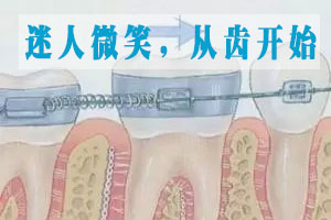 合肥儿童牙齿拥挤矫正费用？