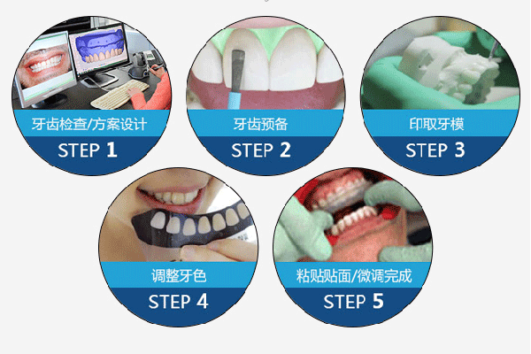 合肥瓷贴面美白牙齿多少钱一颗？