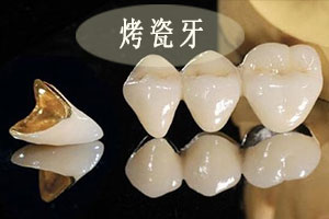 钴铬合金烤瓷牙价格