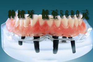 哪种种植牙系统好？