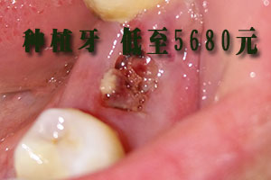 缺牙图片
