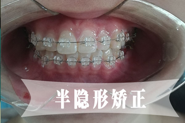 合肥矫正牙齿要多少钱？