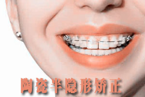 合肥牙齿矫正器多少钱