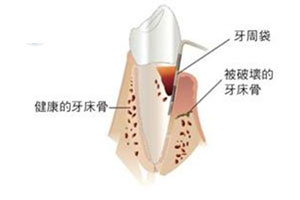 牙周炎治疗方法？
