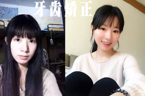 牙齿矫正在合肥多少钱？