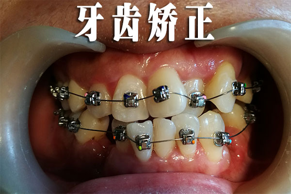 合肥的口腔牙科矫正牙齿？