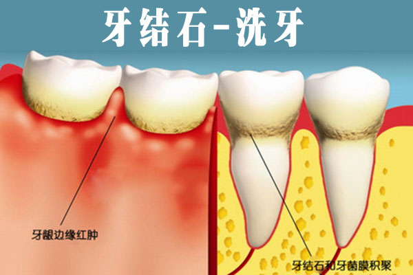 牙周炎该怎么治疗？