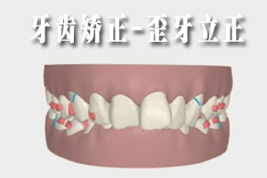 牙齿深覆牙合能矫正吗？