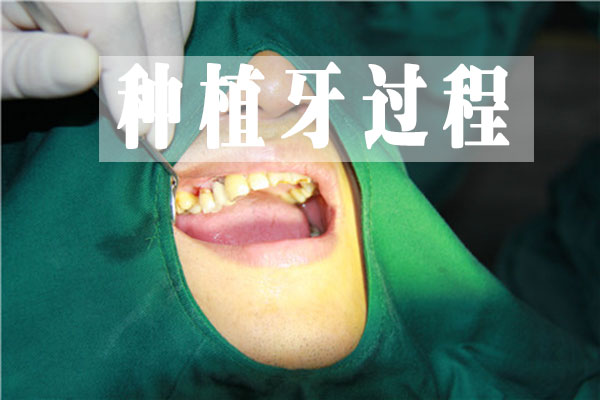 种植牙结果怎么样