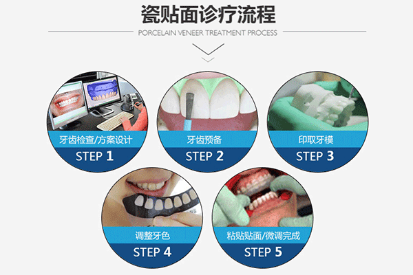 合肥瓷贴面要多少钱一颗？