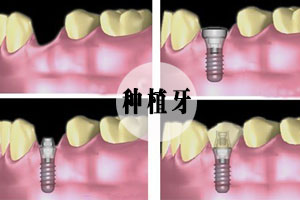 合肥镶牙需要多少钱？