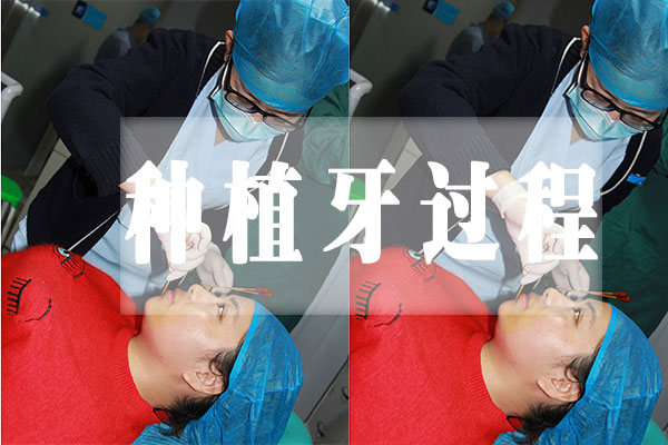 佳德口腔种植牙直播2