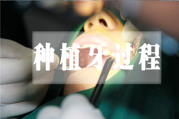 佳德口腔种植牙直播2