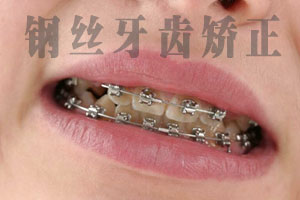 合肥小孩牙齿矫正疼吗