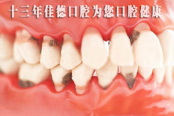 合肥补牙要多少钱一颗