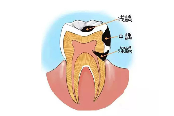 合肥补牙哪个医院好