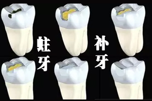 合肥的口腔医院补牙多少钱？