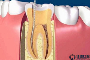 合肥根管的治疗蛀了牙多少钱？