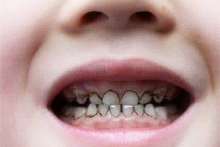 合肥儿童蛀了牙牙疼怎么办