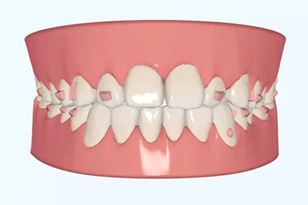合肥牙齿矫正方法