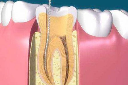 根管的治疗过程
