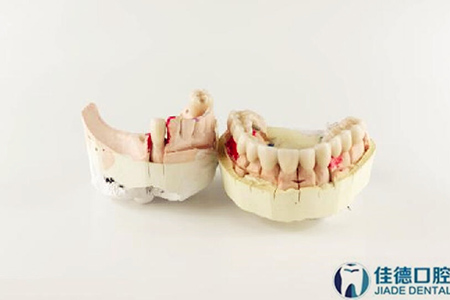 合肥牙齿根管的治疗多少钱？