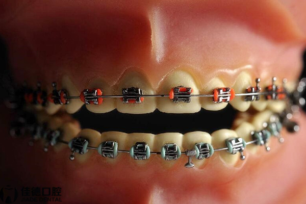 合肥牙齿矫正器价格
