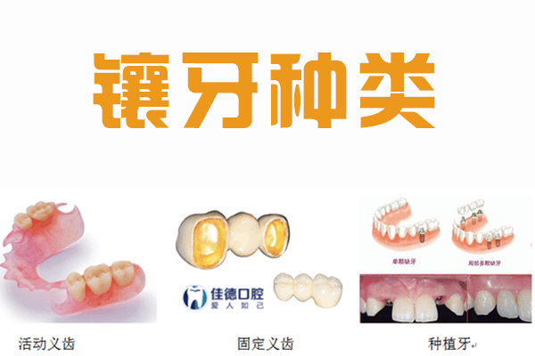 合肥镶牙多少钱？