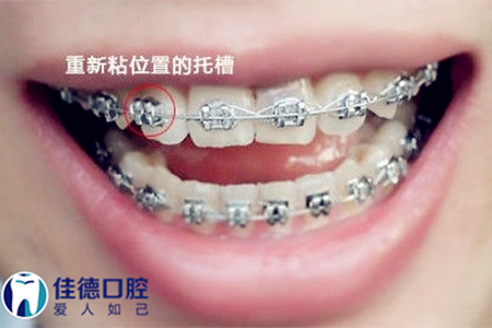 合肥矫正牙齿要多少钱？