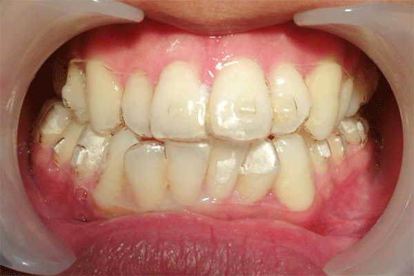 牙颌面畸形矫正的适合时间是什么时候？