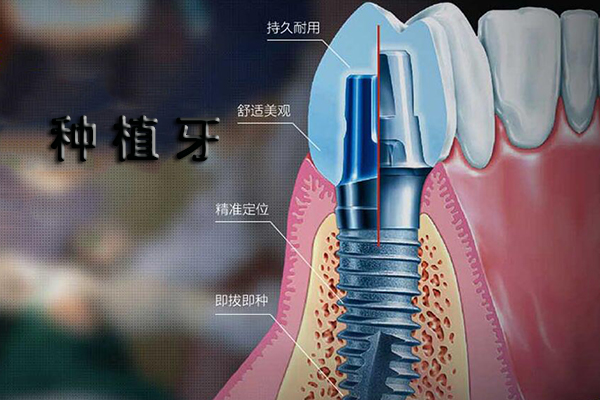 合肥种植牙价格