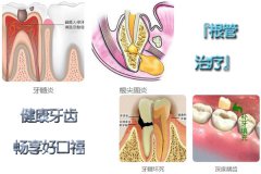 在合肥看根管的治疗多少钱？