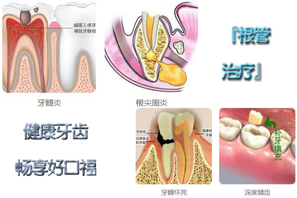 合肥根管的治疗价格