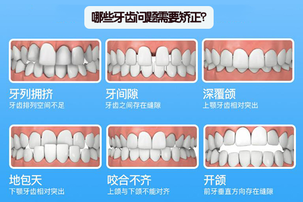 牙齿畸形种类