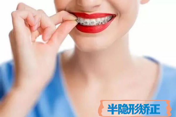 合肥半隐形矫正价格