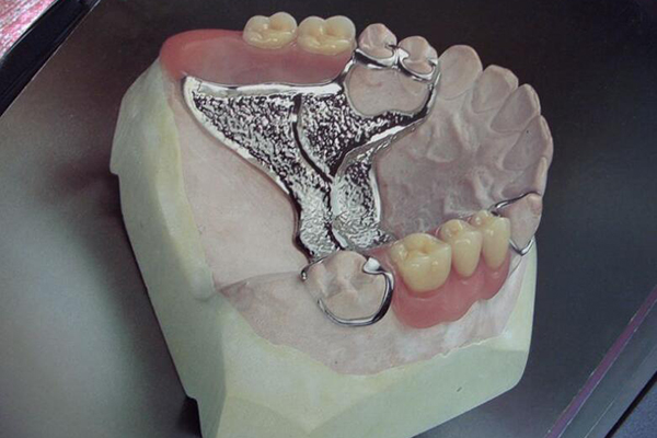 小支架活动义齿图片