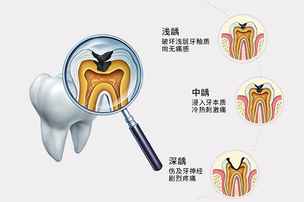 补牙多少钱一颗