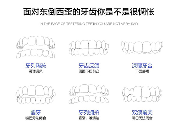 牙齿矫正种类