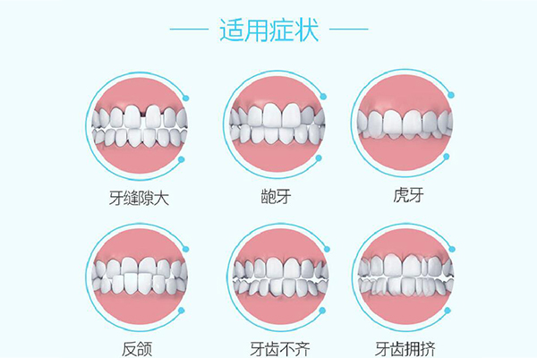 牙齿矫正适应症