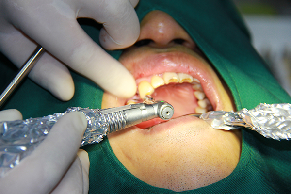 种植牙手术
